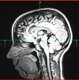 Snímek struktury mozku zkoumané osoby pomocí funkční magnetické rezonance (3)