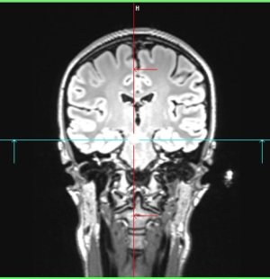 Snímek z magnetické rezonance